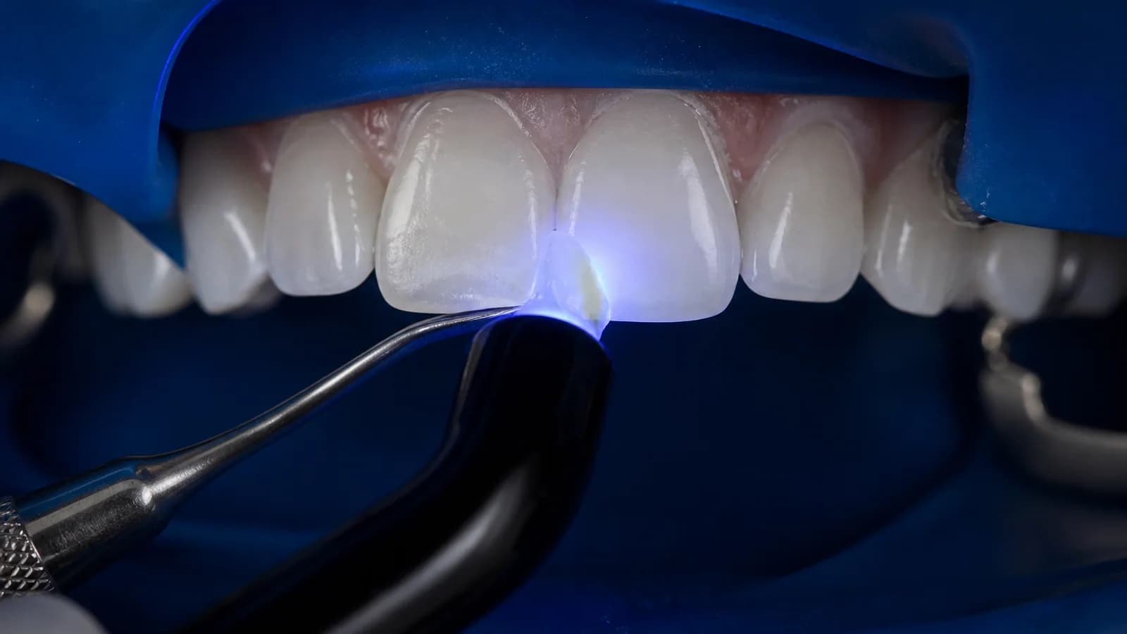 Procedimiento odontológico con resina dental